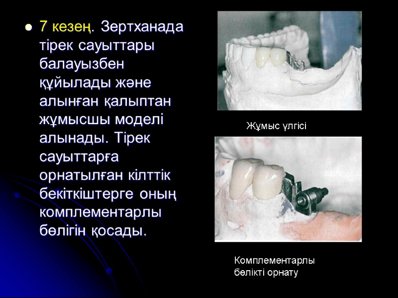 7 кезең. Зертханада тірек сауыттары балауызбен құйылады және алынған қалыптан жұмысшы моделі алынады. Тірек